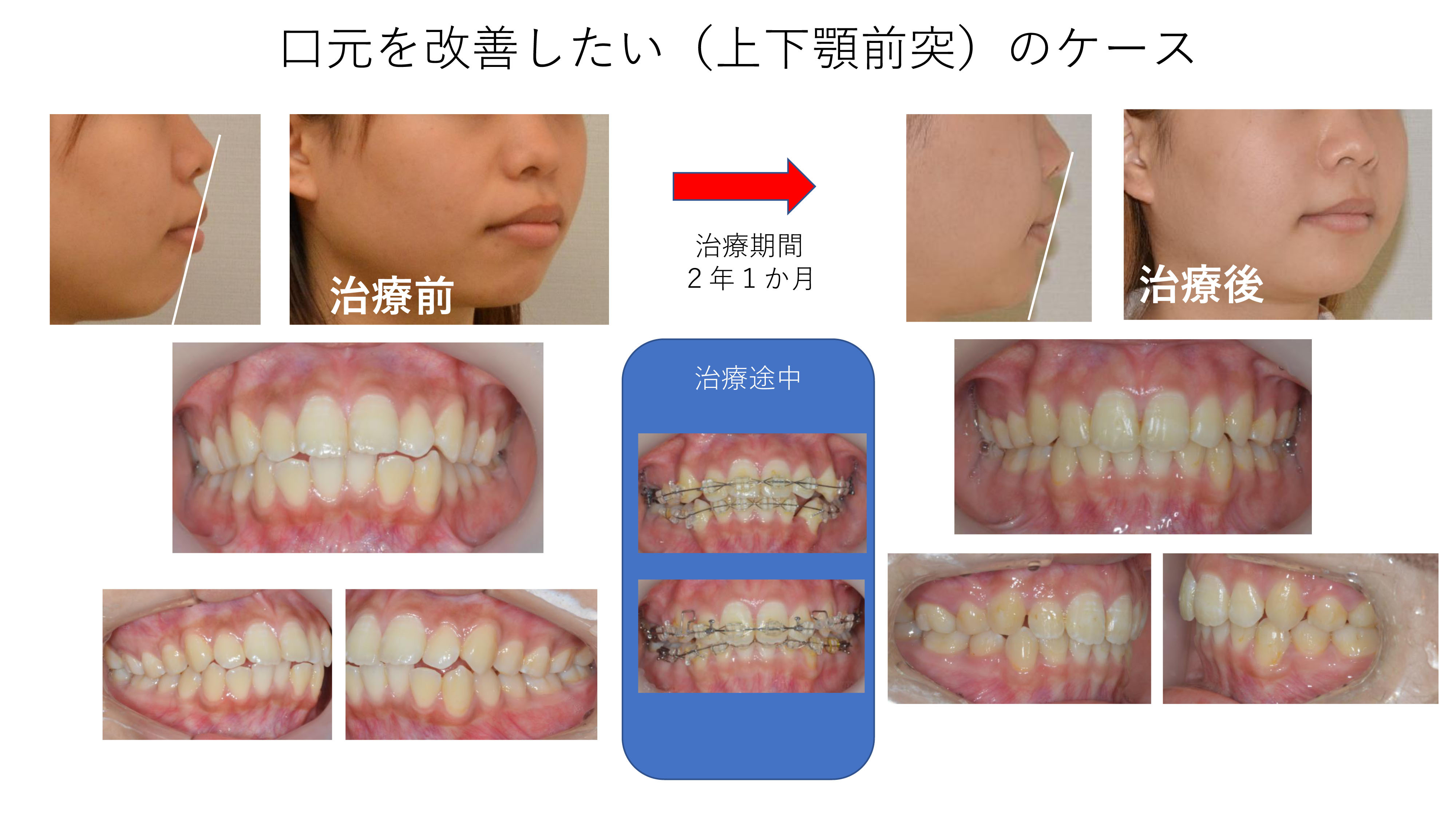 大人の矯正の実際（上下顎前突）