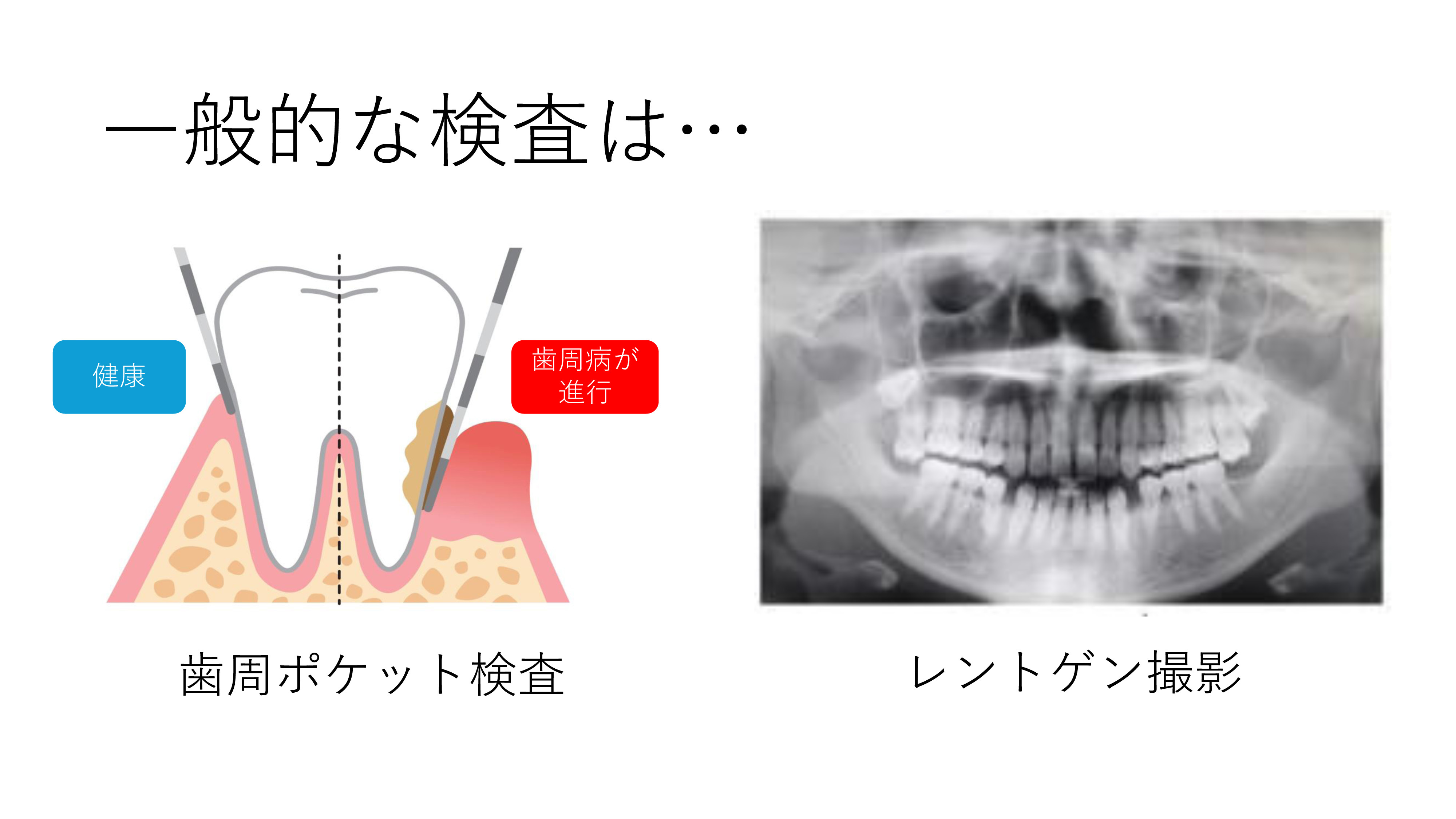 歯周検査-1