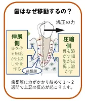 マルチブラケット治療